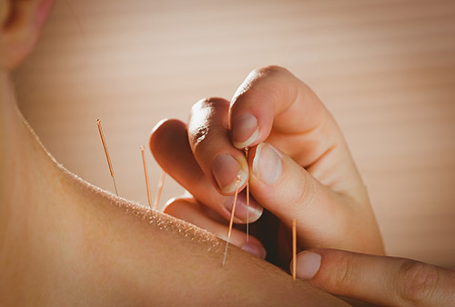 Acupuncture Needles